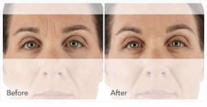 xeomin before and after